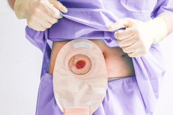 Ostomizado pode fazer Pilates? Saiba tudo aqui