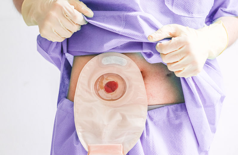 Ostomizado pode fazer Pilates? Saiba tudo aqui
